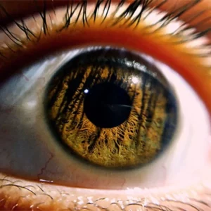 YAG Laser Course – 1-Day Glaucoma Laser Training